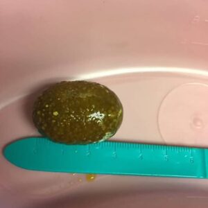 胆结石出售
