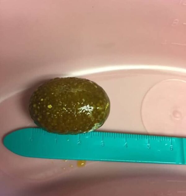胆结石出售